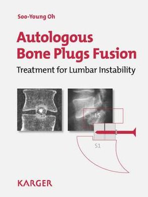 Autologous Bone Plugs Fusion magazine reviews